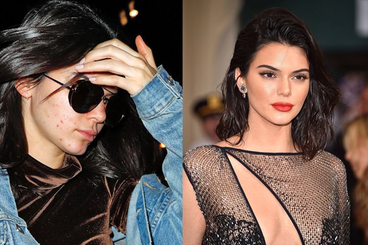 Ever had acne, these are 5 famous Hollywood celebrities who managed to overcome it