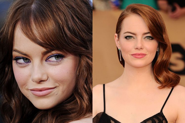 Ever had acne, these are 5 famous Hollywood celebrities who managed to overcome it