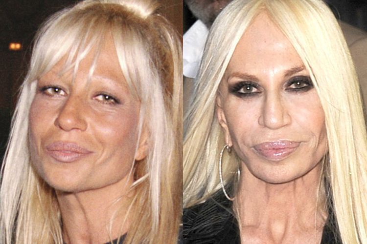 Addicted to plastic surgery, the 7 faces of the world singer are becoming more and more amazing