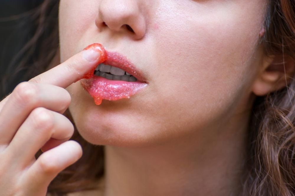 9 Tips Mengatasi Bibir Kering dan Pecah-pecah, Gampang Banget!
