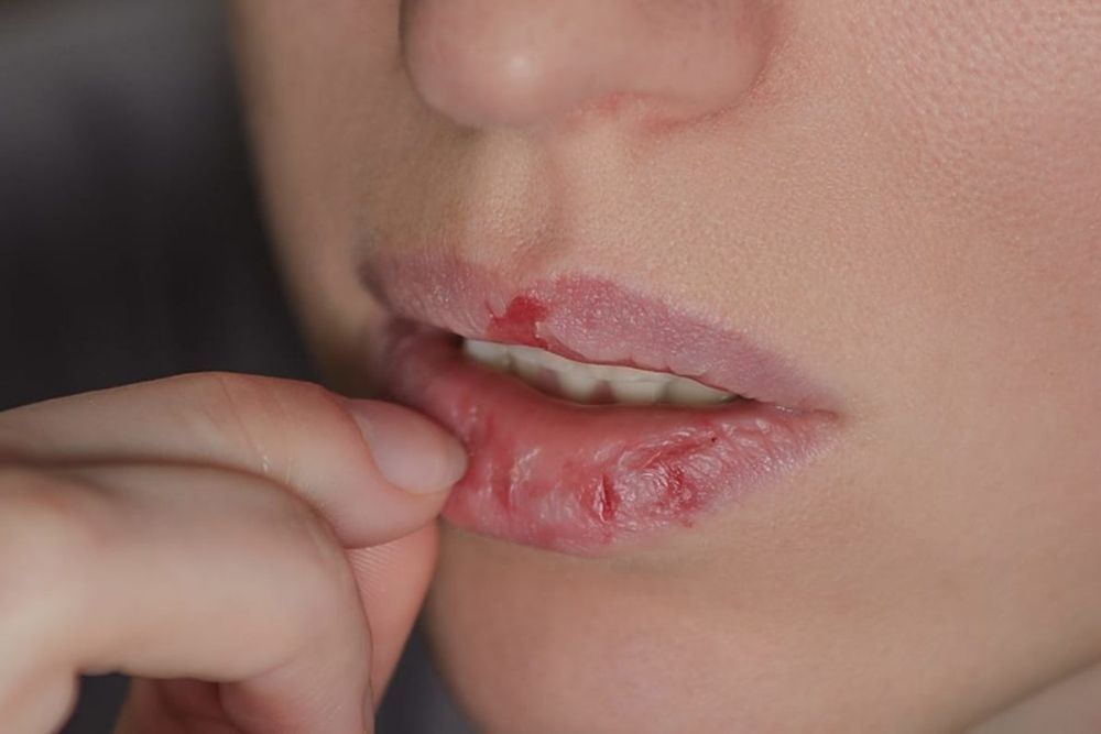 9 Tips Mengatasi Bibir Kering dan Pecah-pecah, Gampang Banget!