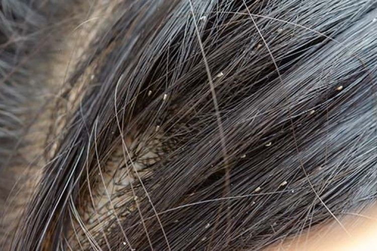 10 Cara Menghilangkan Telur Kutu di Rambut Menggunakan Bahan Alami 