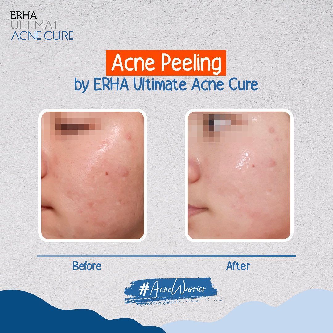 Live a Healthy Life and Do This Treatment for Acne Free Skin